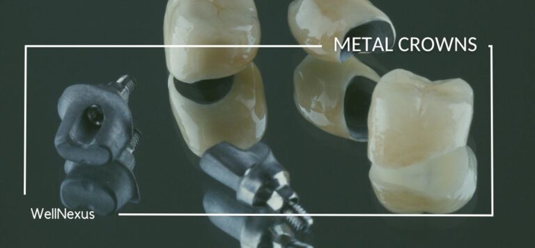 what dentists do metal crowns