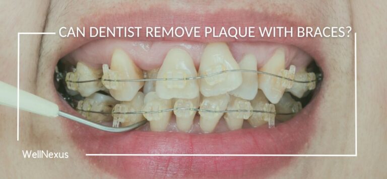 can dentist remove plaque with braces