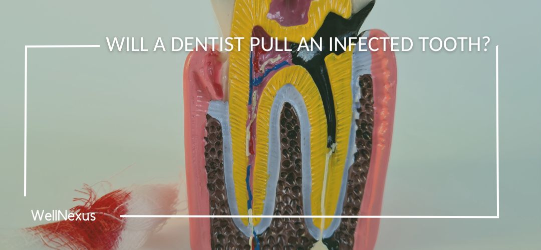 will a dentist pull an infected tooth​